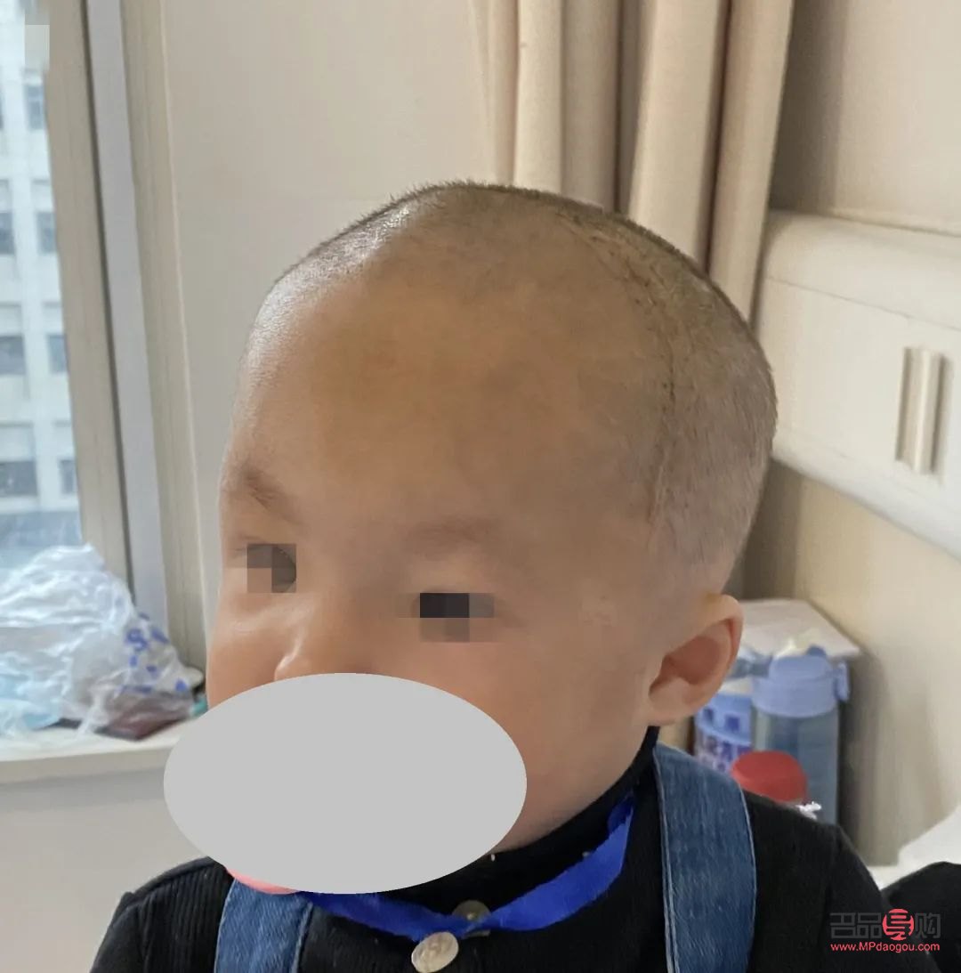 <h3>顱縫早閉與大小眼的關系探究</h3>