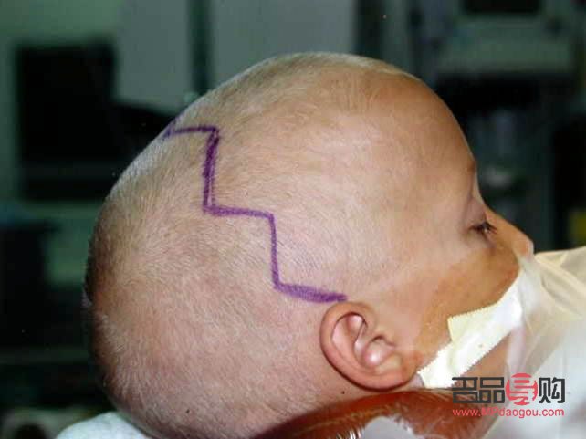 顱縫早閉與大小眼的關系探究