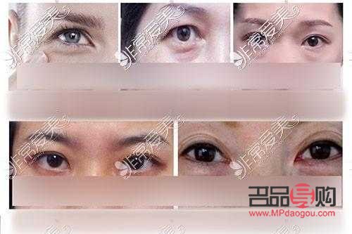眼袋去除手術費用知多少