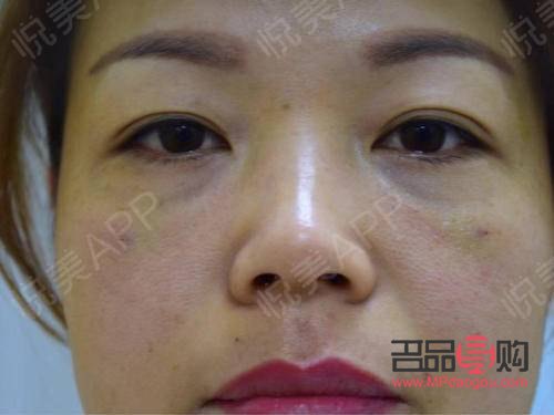 內切祛眼袋手術效果能持續多久？