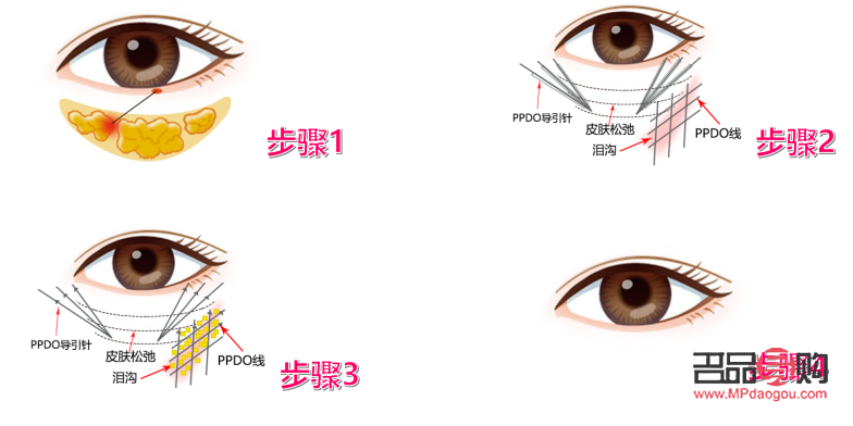 <h3>醫美去眼袋手術可能帶來的后遺癥</h3>