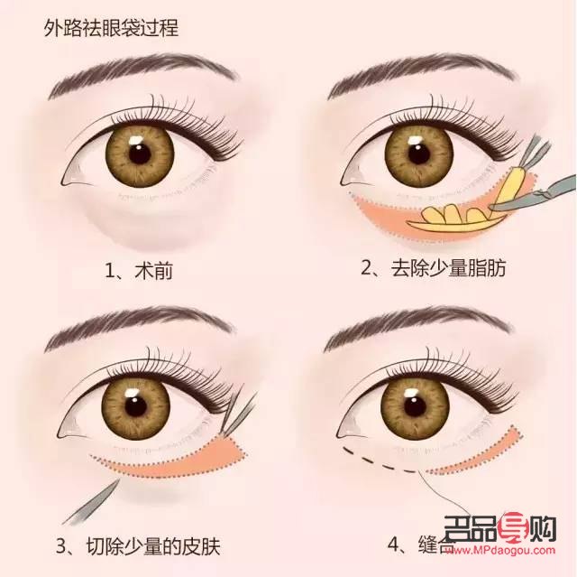 醫美去眼袋手術可能帶來的后遺癥