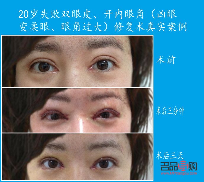 開眼角割雙眼皮恢復期詳解