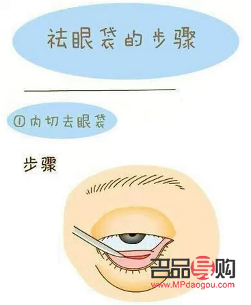 探究眼袋內(nèi)切手術的費用及相關因素
