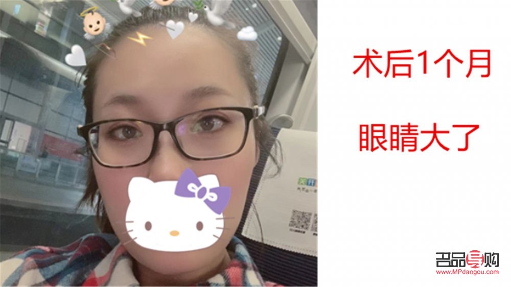 天生眼泡腫怎么辦？有效緩解眼泡腫脹的方法與建議