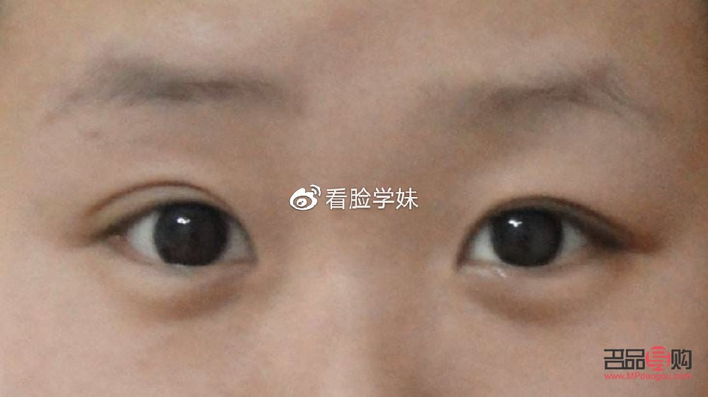 兩個眼皮雙的不一樣怎么辦