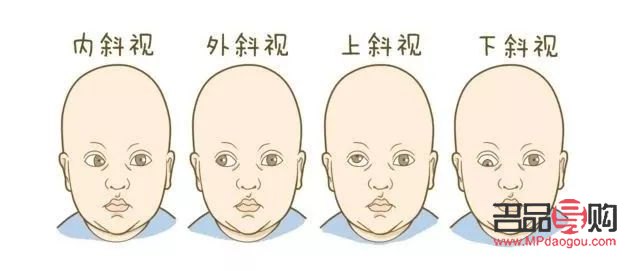 外斜視眼恢復最簡單方法(間歇性外斜視眼恢復最簡單方法)