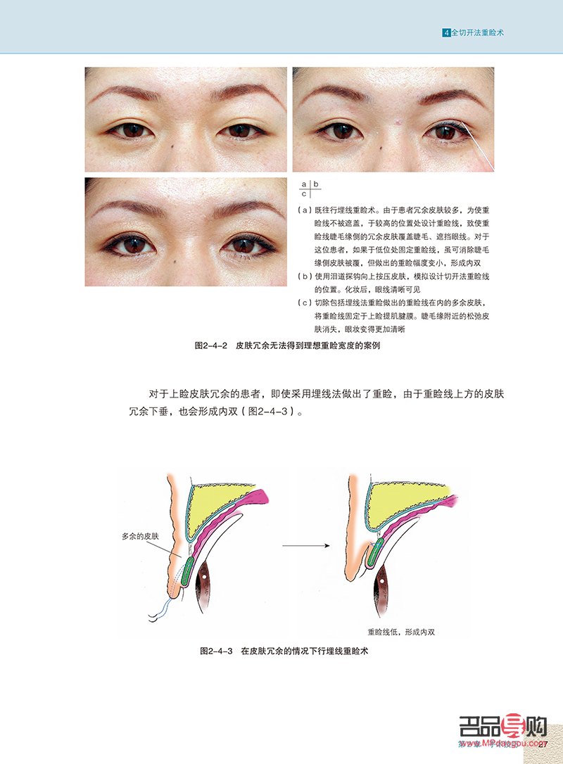 眼整形美容手術(眼整形美容手術圖譜)