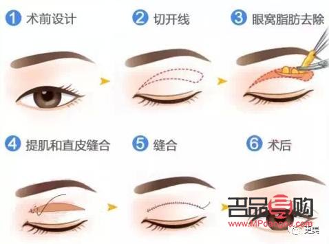 雙眼皮那種款式最好看(雙眼皮那種款式最好看圖片)