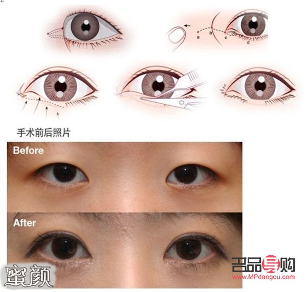 開眼角的圖片前后對(duì)比(開眼角圖片前后對(duì)比照片效果圖)