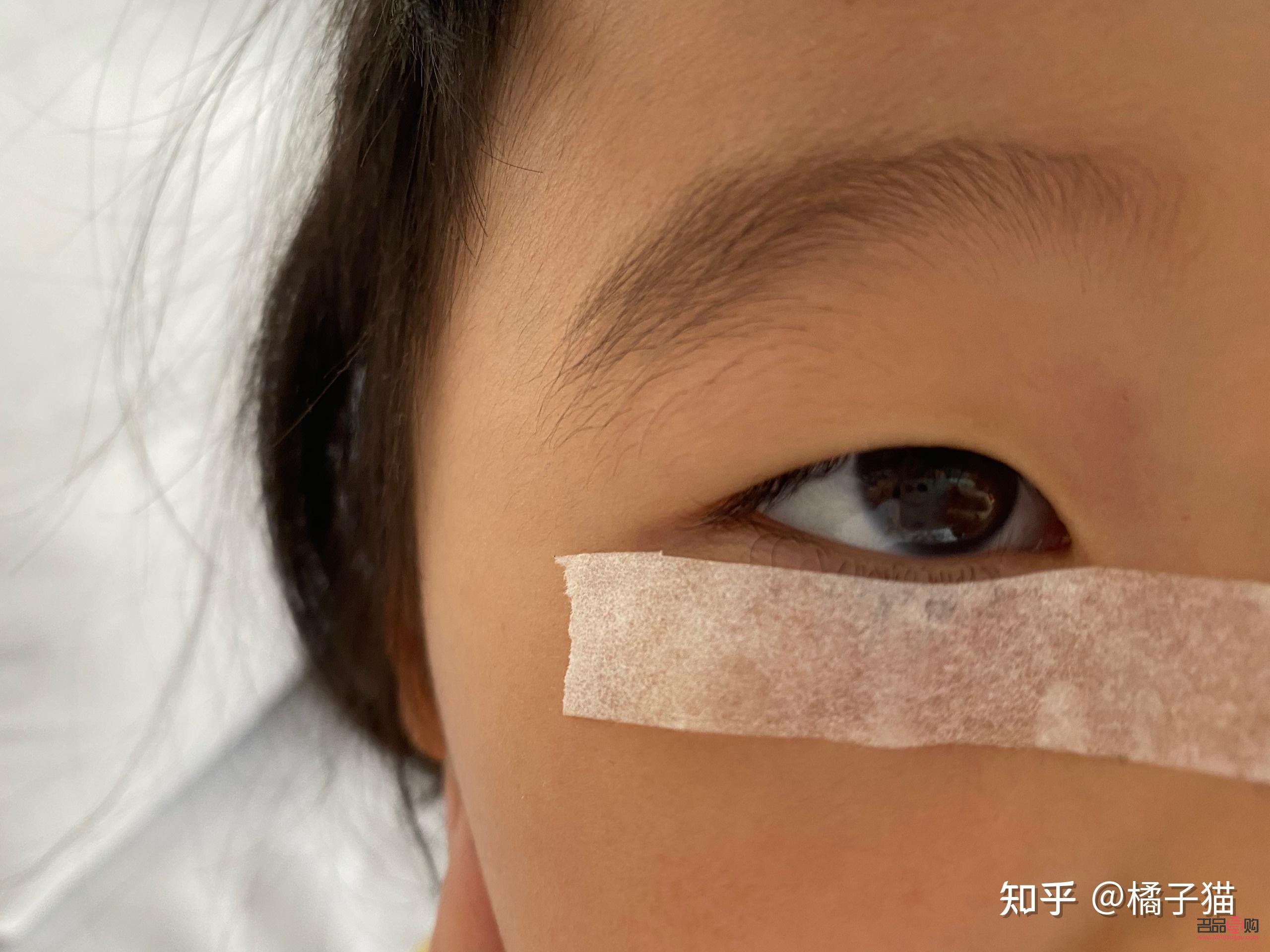下眼瞼倒睫手術多少錢醫保報銷(下眼瞼倒睫手術可以報銷嗎)