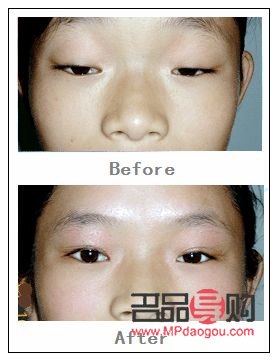 眼皮下垂最佳非手術解決方案