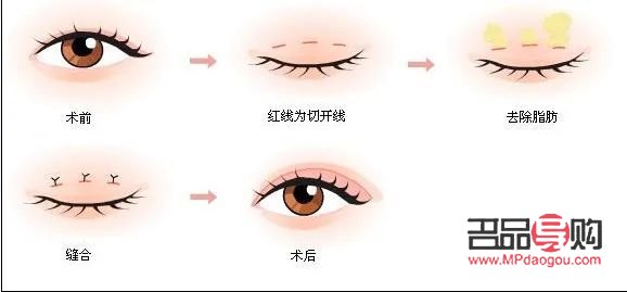 四種雙眼皮的圖片(四種雙眼皮的圖片下眼有交叉紋怎么辦)