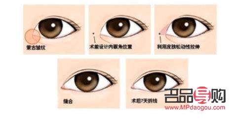 天生腫眼泡做手術多少錢(天生腫眼泡做手術多少錢一次)