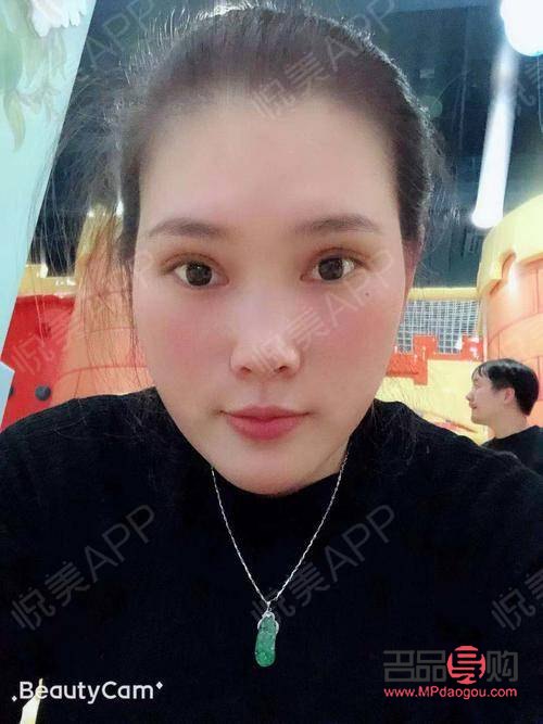 割雙眼皮多久可以出去玩(割雙眼皮多長時間可以出門)