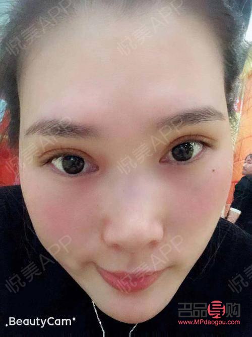 割雙眼皮多久可以出去玩(割雙眼皮多長時間可以出門)