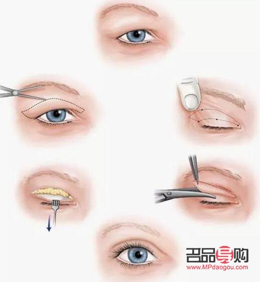 什么季節(jié)做雙眼皮手術(shù)最好(什么季節(jié)做雙眼皮手術(shù)最好呢)