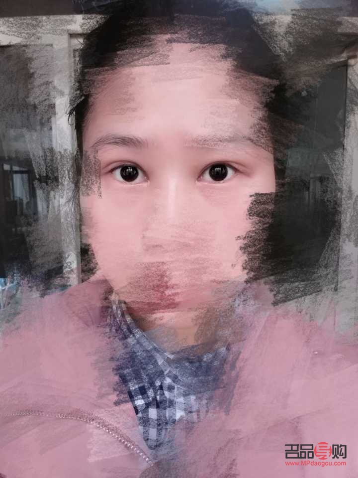 如何矯正一個(gè)眼大一個(gè)眼小的問題