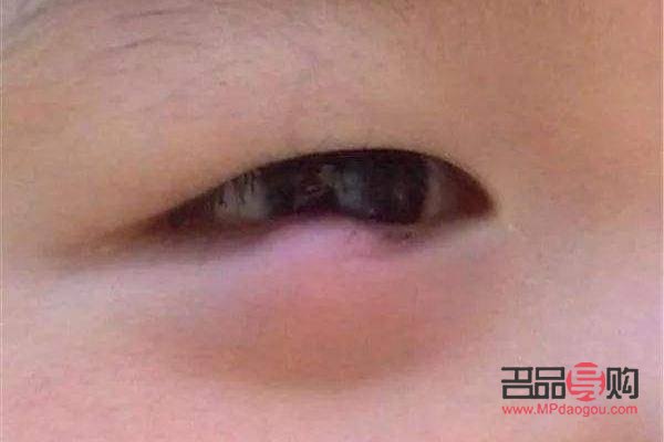 眼睛老長針眼是什么原因(眼睛老長針眼是什么原因引起的)