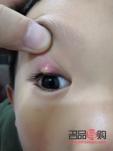 眼睛老長(zhǎng)針眼是什么原因(眼睛老長(zhǎng)針眼是什么原因引起的)