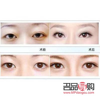 韓式翹睫雙眼皮(韓式翹睫雙眼皮的做法)