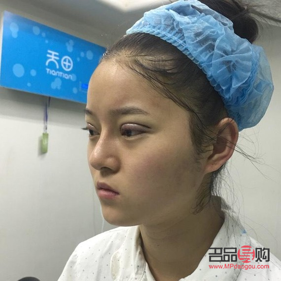 <h3>47歲，我選擇割雙眼皮——重塑自信的美麗之旅</h3>