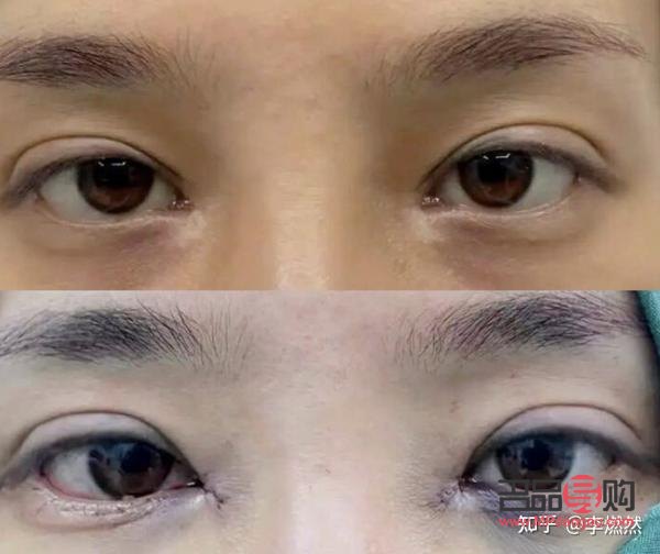 割了雙眼皮還是內雙(割了雙眼皮還是內雙好看)