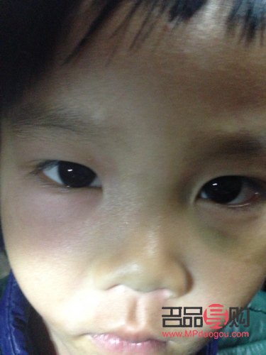 小孩子眼睛下面腫是怎么回事(小孩子眼睛下面腫是怎么回事兒)