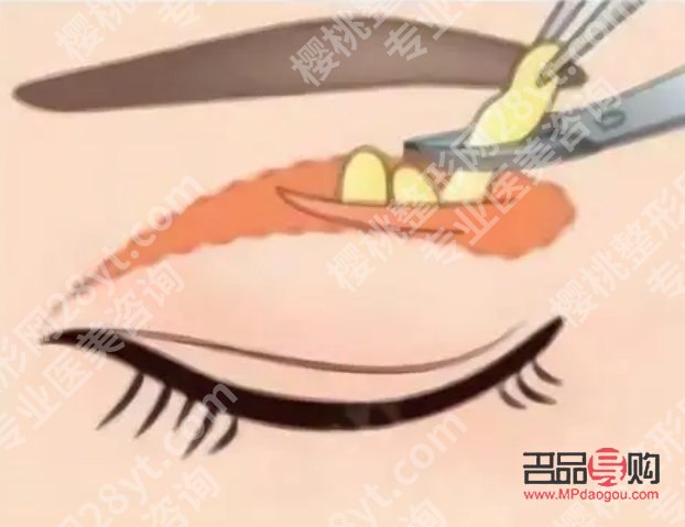 眼皮去脂肪手術費用大概是多少？