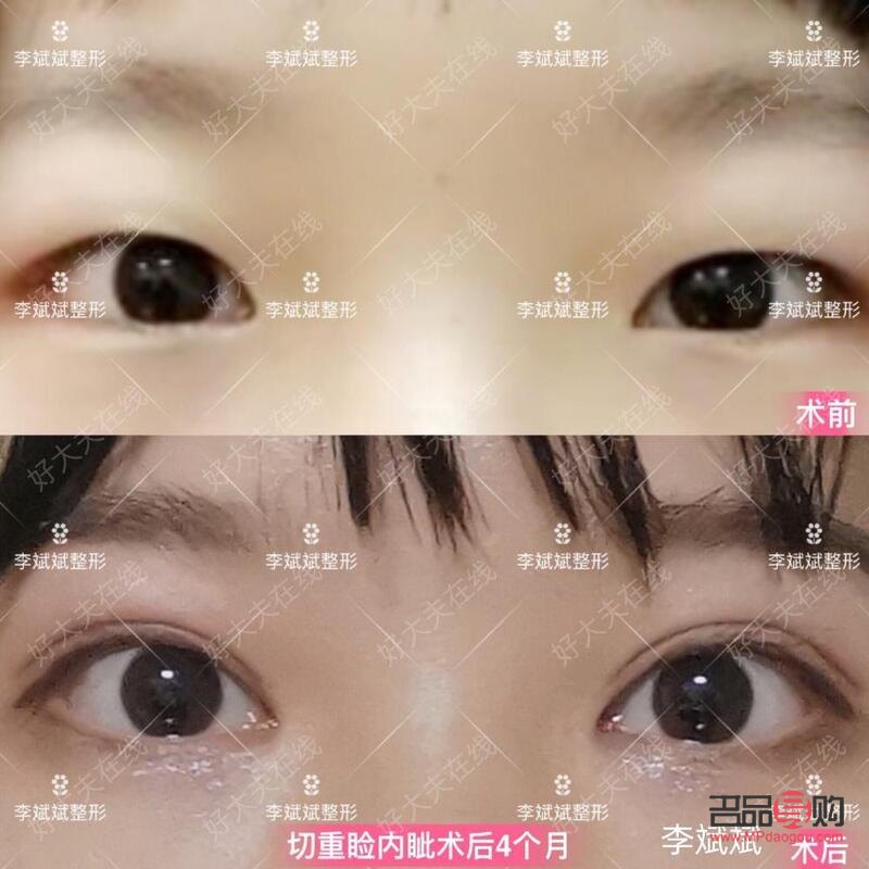 桃花眼雙眼皮手術(桃花眼雙眼皮手術怎么做)