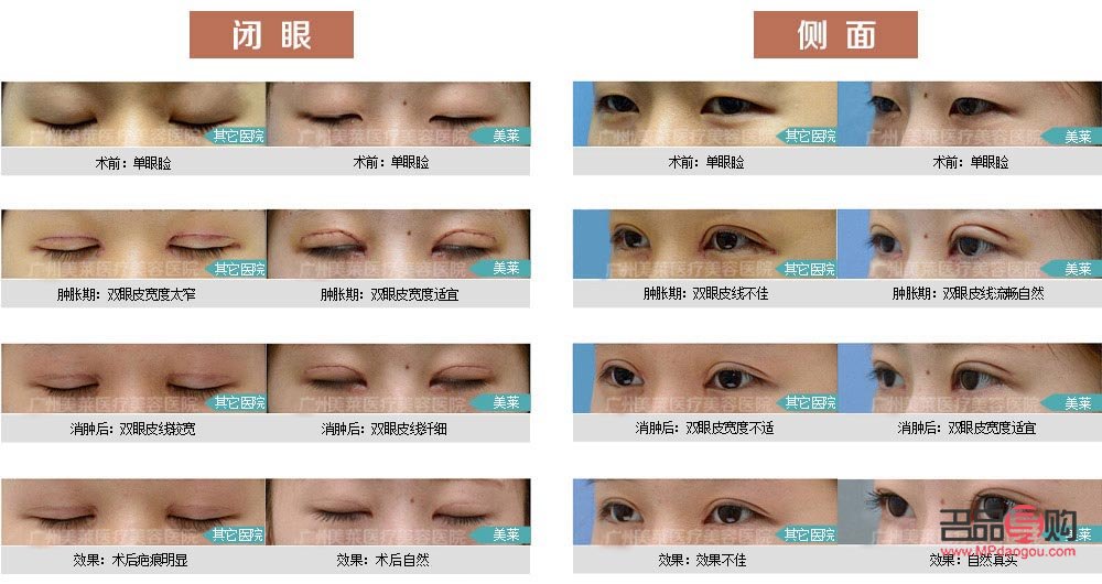 翹睫雙眼皮和全切有什么區別圖片(翹睫雙眼皮和全切有什么區別圖片對比)