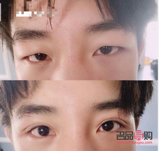 男生割雙眼皮最佳年齡(男生割雙眼皮最佳年齡是多少)