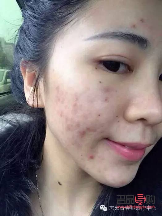 痘肌彩妝怎么選(痘肌彩妝怎么選顏色)