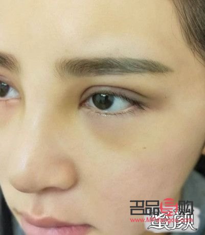<h3>雙眼皮窄了，如何優雅地加寬？</h3>