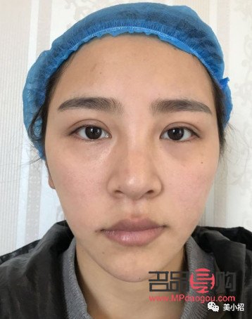 雙眼皮窄了，如何優雅地加寬？