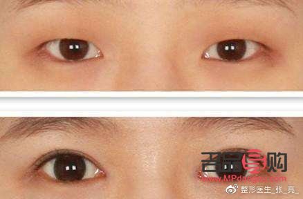 正常眼睛和腫泡眼圖片側面(正常眼泡和腫眼泡)