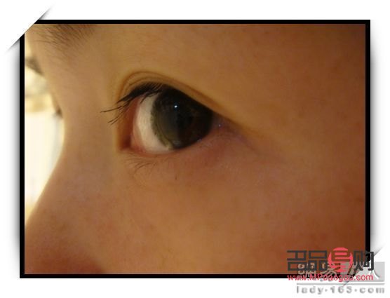 正常眼睛和腫泡眼圖片側面(正常眼泡和腫眼泡)