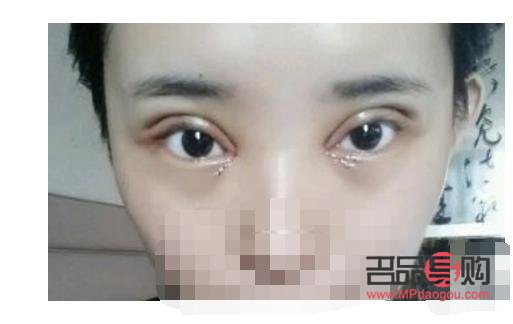 割雙眼皮多久消腫？專業解答與護理建議