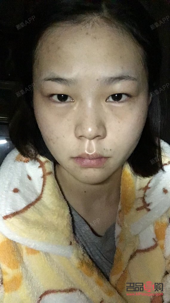 <h3>天生腫眼泡怎么消除？不手術也能做到！</h3>