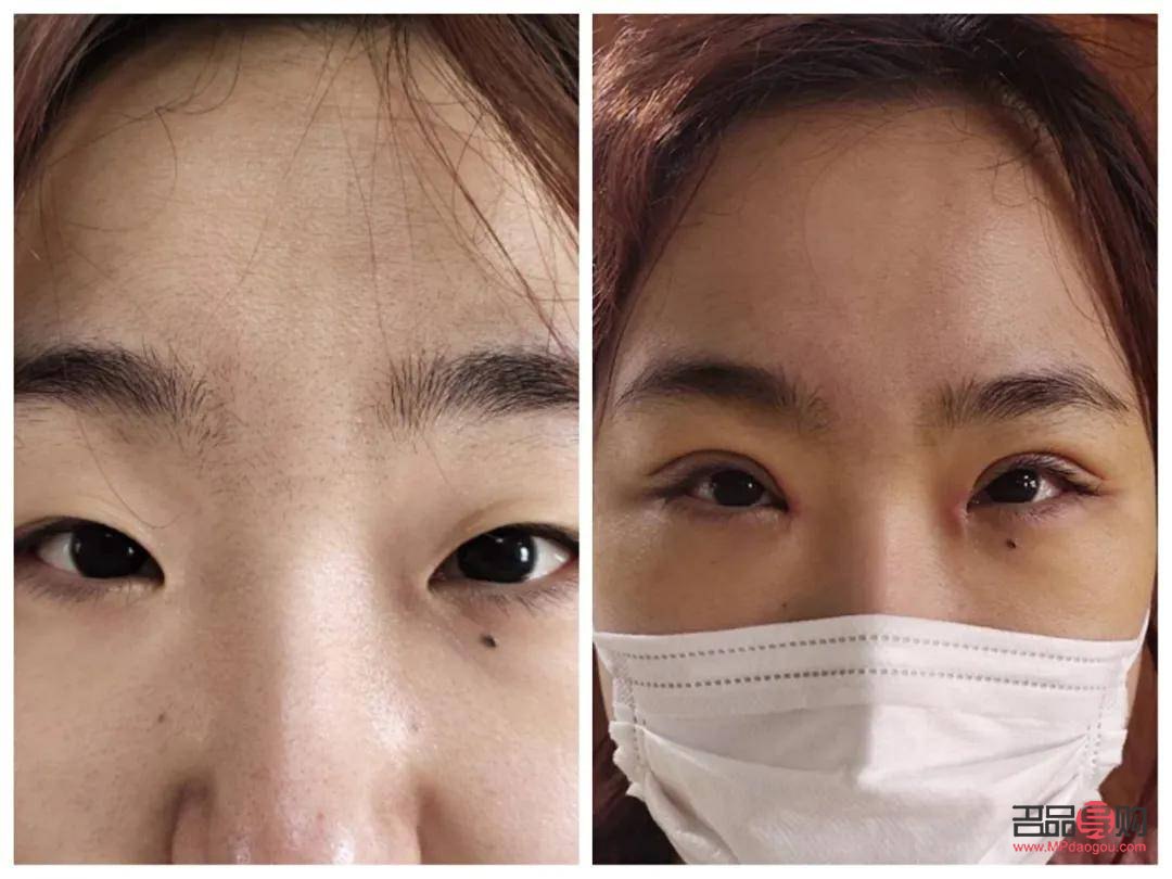 天生腫眼泡怎么消除？不手術也能做到！