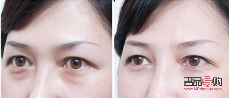 眼袋與臥蠶：如何準確區分？