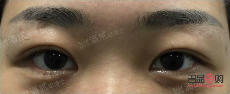 如何改善大小眼問題(如何改善大小眼問題的方法)