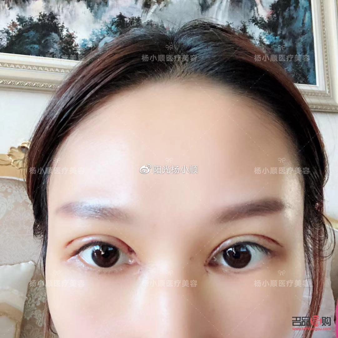 <h3>雙眼皮手術恢復自然需要多久？</h3>