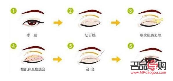 雙眼皮手術恢復自然需要多久？