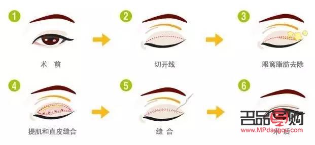 <h3>探究腫眼泡的成因及影響因素</h3>