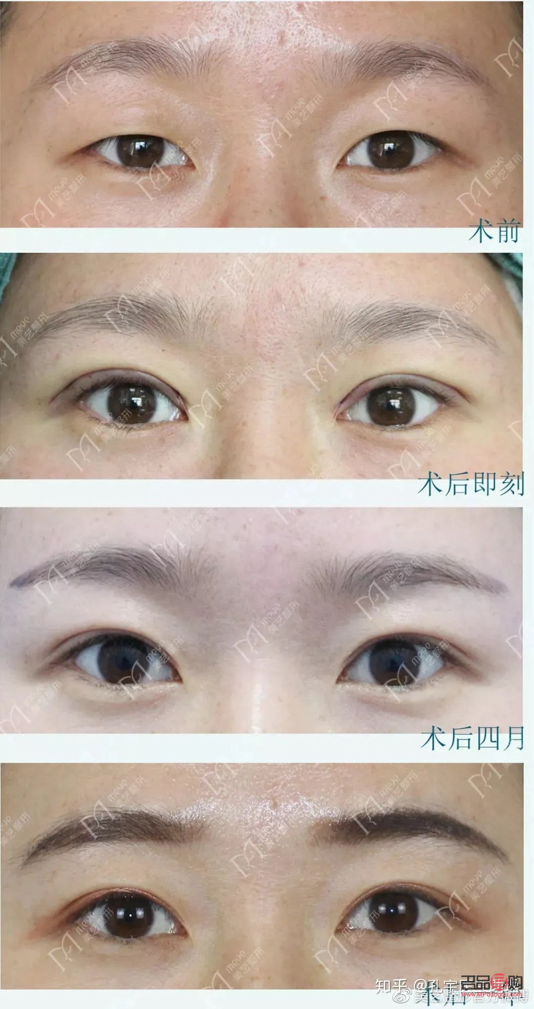 探究腫眼泡的成因及影響因素