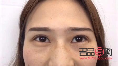 上眼瞼提肌手術圖解(上眼瞼提肌手術圖解視頻)
