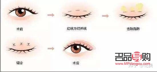 6d無痕雙眼皮多久才能恢復(6d無痕雙眼皮多久才能恢復自然)