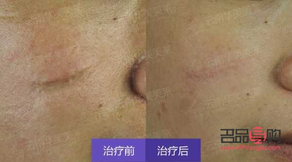 凹疤美容有用嗎(凹疤美容有用嗎圖片)