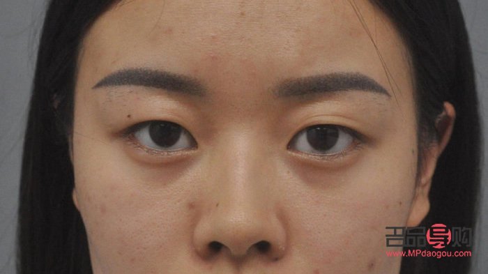 <h3>解決眼瞼松弛下垂的有效方法</h3>